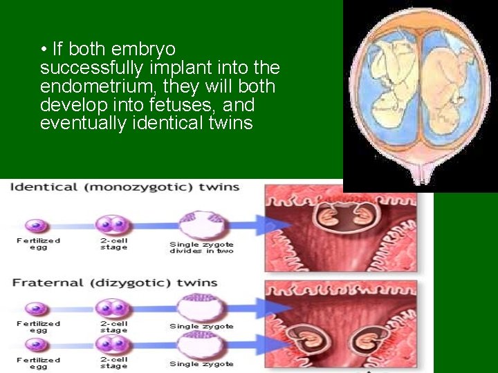 • If both embryo successfully implant into the endometrium, they will both develop  • If both embryo successfully implant into the endometrium, they will both develop