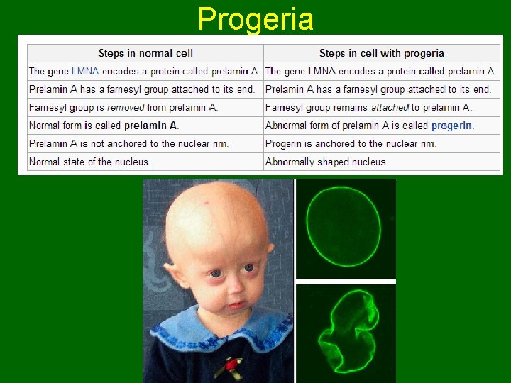 Progeria 