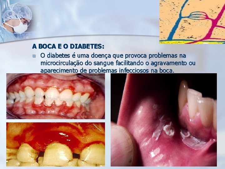 A BOCA E O DIABETES: n O diabetes é uma doença que provoca problemas