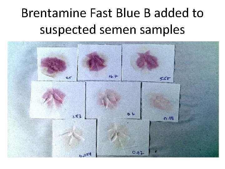 Brentamine Fast Blue B added to suspected semen samples 