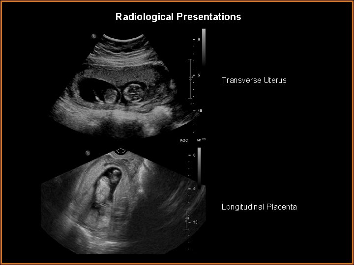 Radiological Presentations Transverse Uterus Longitudinal Placenta 