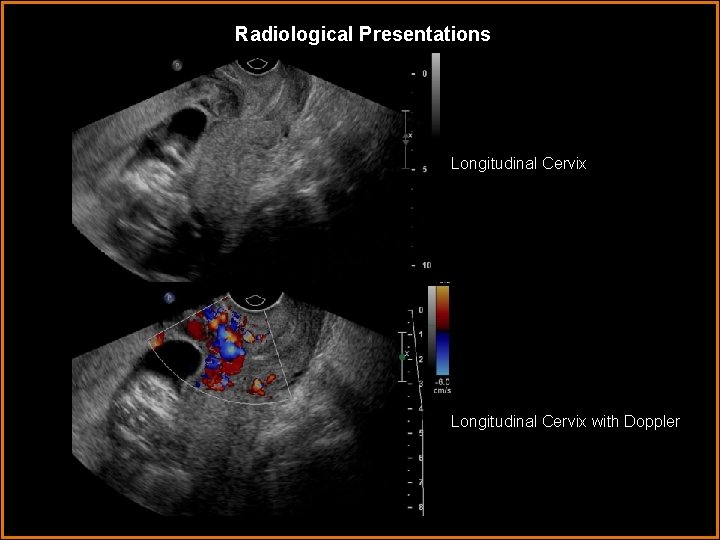 Radiological Presentations Longitudinal Cervix with Doppler 