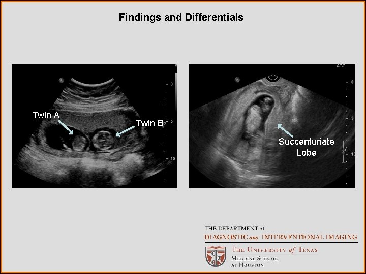 Findings and Differentials Twin A Twin B Succenturiate Lobe 