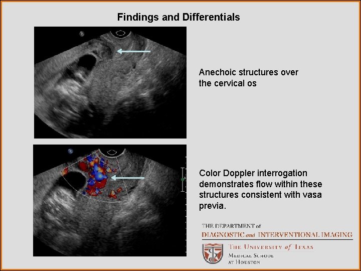 Findings and Differentials Anechoic structures over the cervical os Color Doppler interrogation demonstrates flow