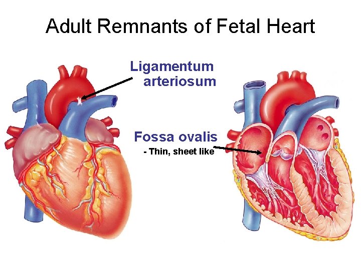 Adult Remnants of Fetal Heart Ligamentum arteriosum Fossa ovalis - Thin, sheet like 