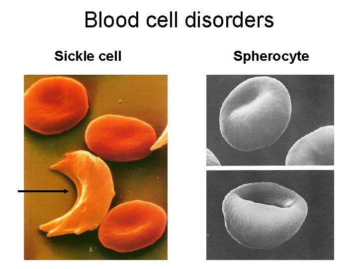 Blood cell disorders Sickle cell Spherocyte 