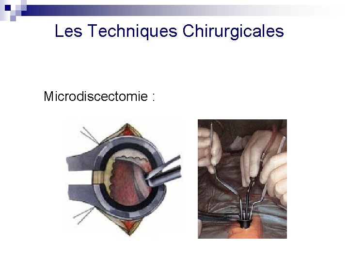 Les Techniques Chirurgicales Microdiscectomie : 