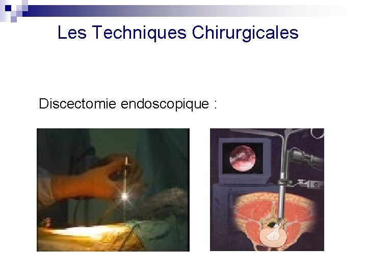 Les Techniques Chirurgicales Discectomie endoscopique : 