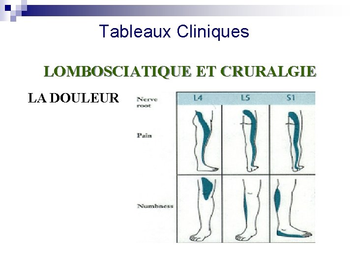 Tableaux Cliniques LOMBOSCIATIQUE ET CRURALGIE LA DOULEUR 