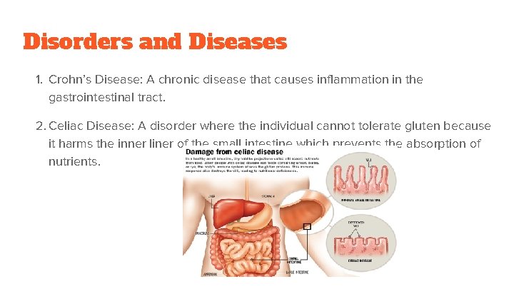 Disorders and Diseases 1. Crohn’s Disease: A chronic disease that causes inflammation in the