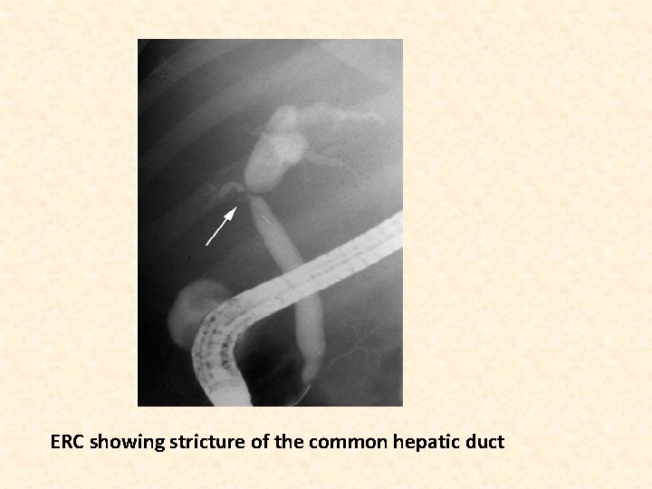 ERC showing stricture of the common hepatic duct 