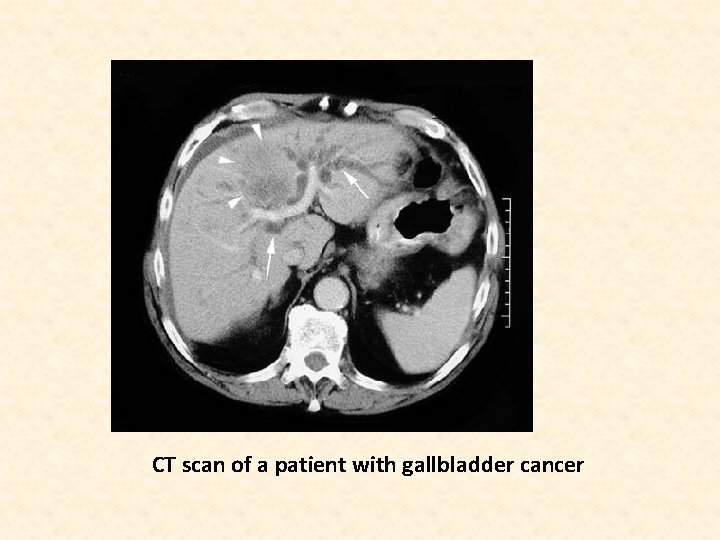 CT scan of a patient with gallbladder cancer 