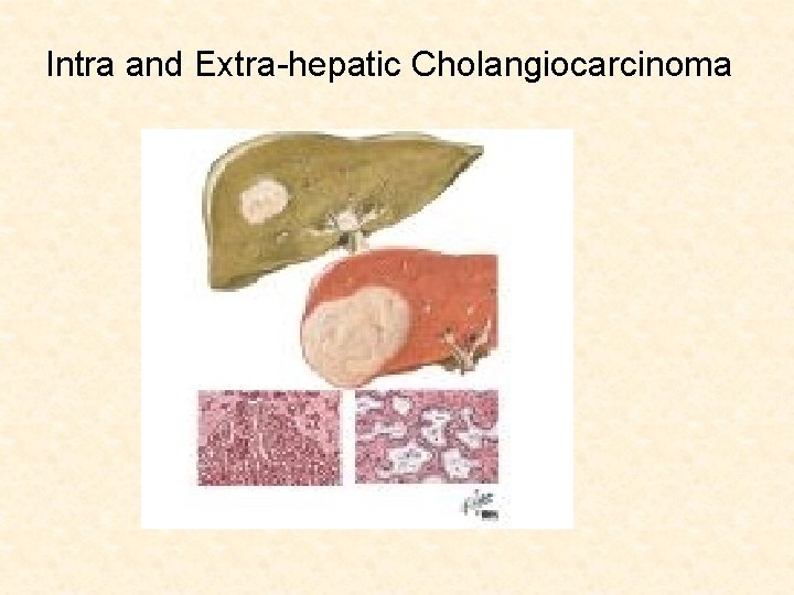 Intra and Extra-hepatic Cholangiocarcinoma 