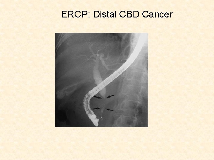 ERCP: Distal CBD Cancer 