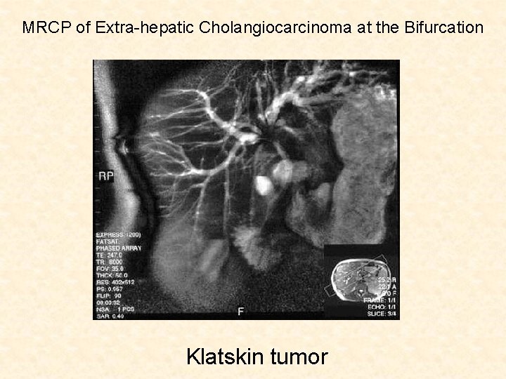 MRCP of Extra-hepatic Cholangiocarcinoma at the Bifurcation Klatskin tumor 