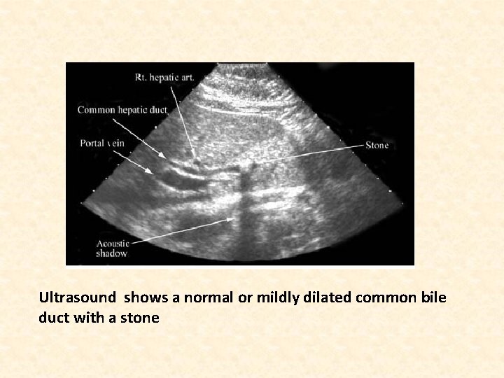 Ultrasound shows a normal or mildly dilated common bile duct with a stone 