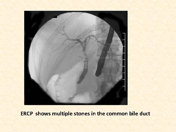 ERCP shows multiple stones in the common bile duct 