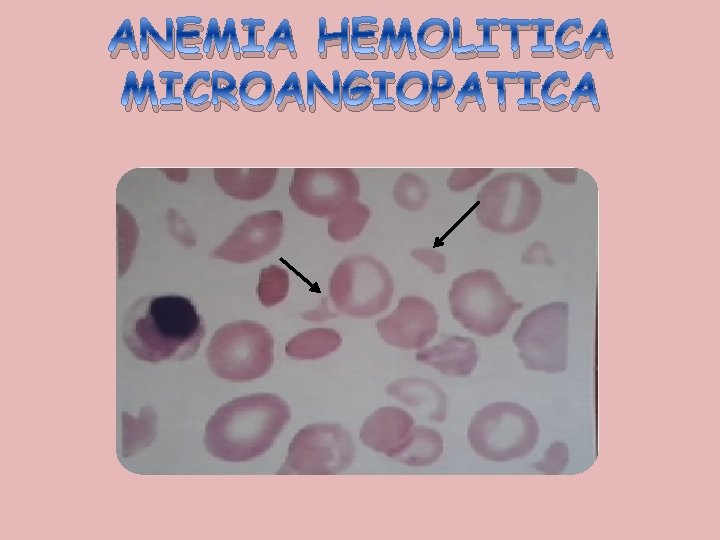 ANEMIA HEMOLITICA MICROANGIOPATICA 