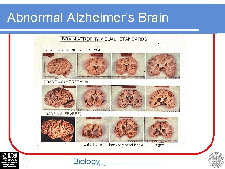 Abnormal Alzheimer’s Brain 