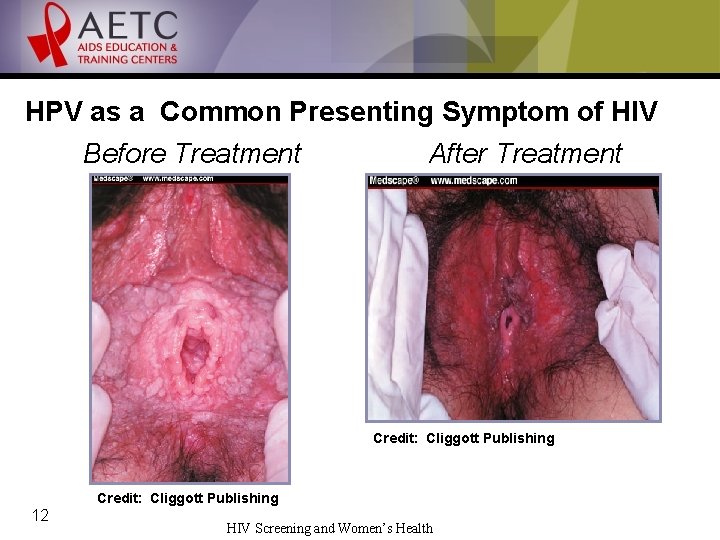 HPV as a Common Presenting Symptom of HIV Before Treatment After Treatment Credit: Cliggott