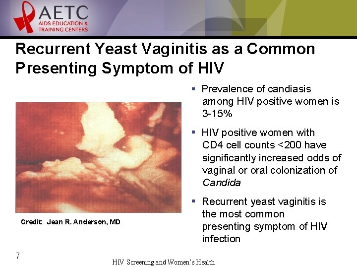 Recurrent Yeast Vaginitis as a Common Presenting Symptom of HIV § Prevalence of candiasis