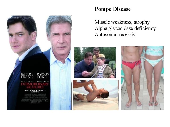 Pompe Disease Muscle weakness, atrophy Alpha glycosidase deficiency Autosomal recessiv 