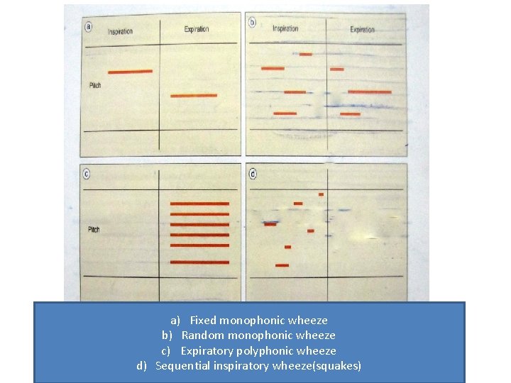 a) Fixed monophonic wheeze b) Random monophonic wheeze c) Expiratory polyphonic wheeze d) Sequential a) Fixed monophonic wheeze b) Random monophonic wheeze c) Expiratory polyphonic wheeze d) Sequential