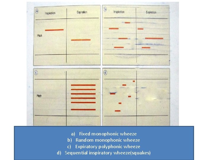 a) Fixed monophonic wheeze b) Random monophonic wheeze c) Expiratory polyphonic wheeze d) Sequential