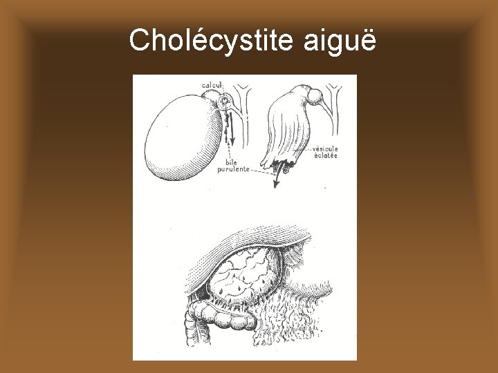 Cholécystite aiguë 