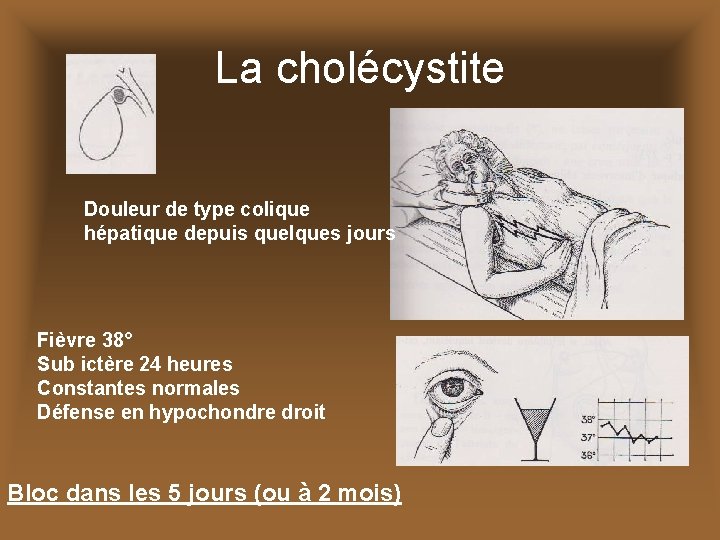 La cholécystite Douleur de type colique hépatique depuis quelques jours Fièvre 38° Sub ictère