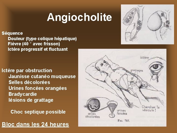 Angiocholite Séquence Douleur (type colique hépatique) Fièvre (40 ° avec frisson) Ictère progressif et