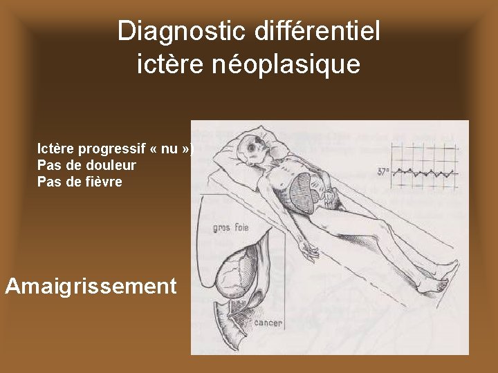 Diagnostic différentiel ictère néoplasique Ictère progressif « nu » ) Pas de douleur Pas