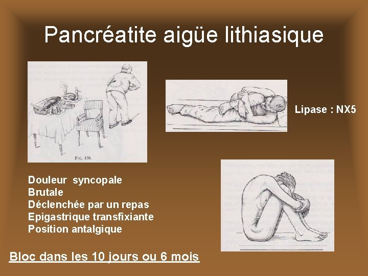 Pancréatite aigüe lithiasique Lipase : NX 5 Douleur syncopale Brutale Déclenchée par un repas