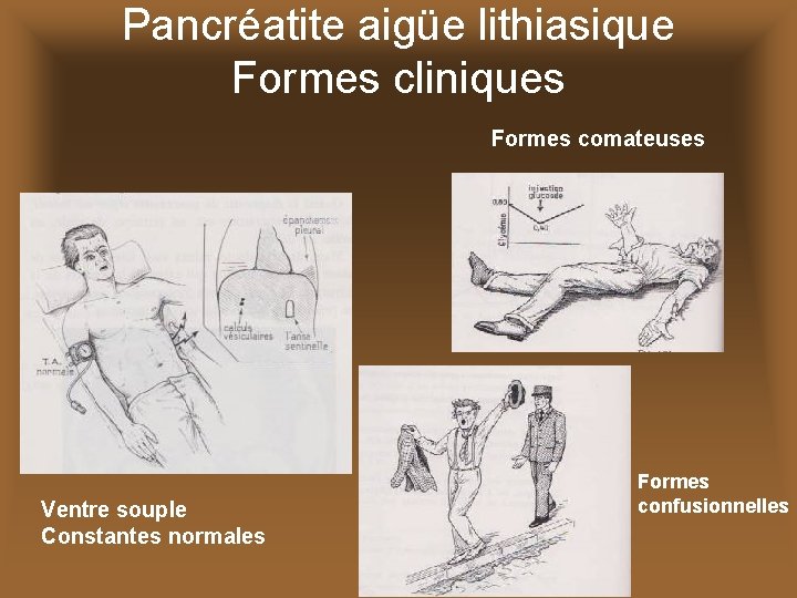 Pancréatite aigüe lithiasique Formes cliniques Formes comateuses Ventre souple Constantes normales Formes confusionnelles 