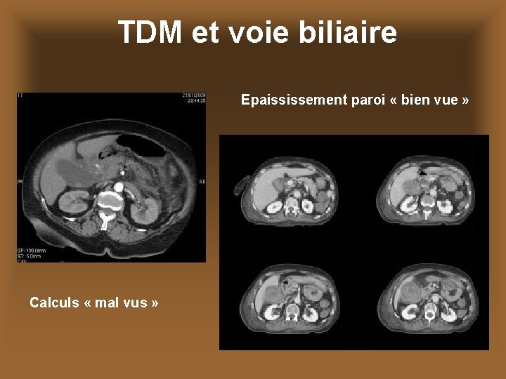 TDM et voie biliaire Epaississement paroi « bien vue » Calculs « mal vus