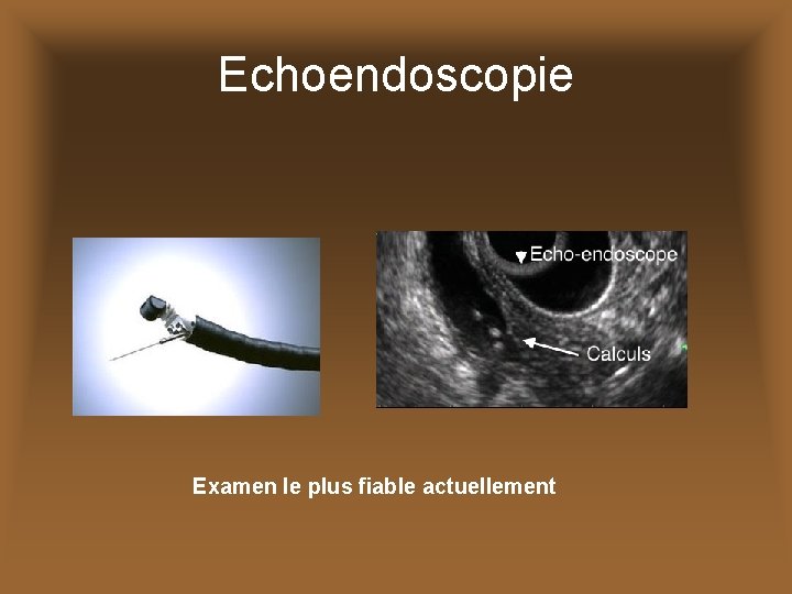 Echoendoscopie Examen le plus fiable actuellement 