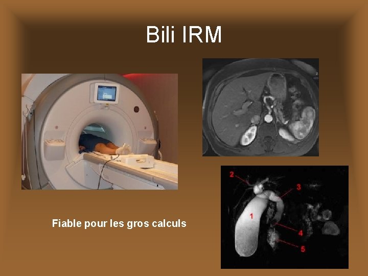 Bili IRM Fiable pour les gros calculs 