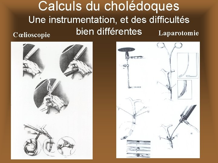 Calculs du cholédoques Une instrumentation, et des difficultés bien différentes Laparotomie Cœlioscopie 