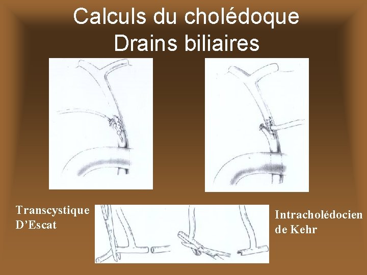 Calculs du cholédoque Drains biliaires Transcystique D’Escat Intracholédocien de Kehr 