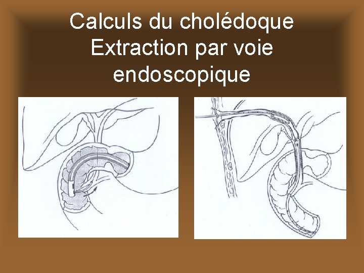 Calculs du cholédoque Extraction par voie endoscopique 