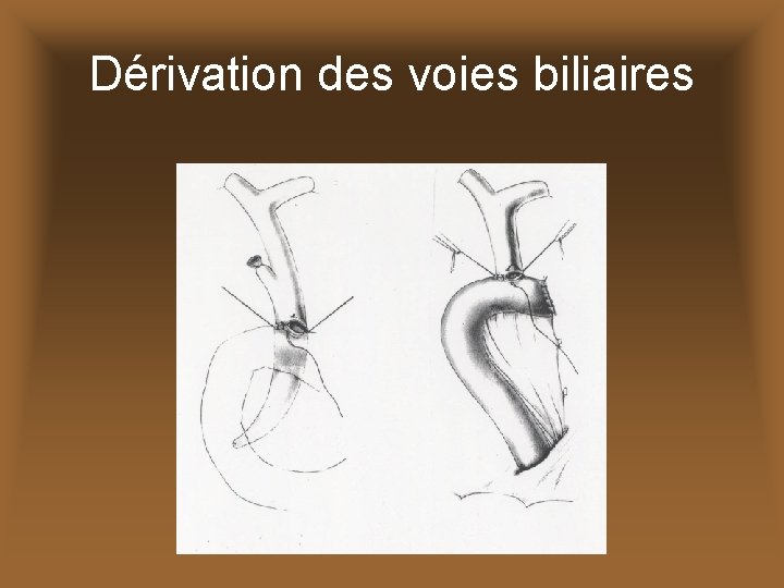 Dérivation des voies biliaires 