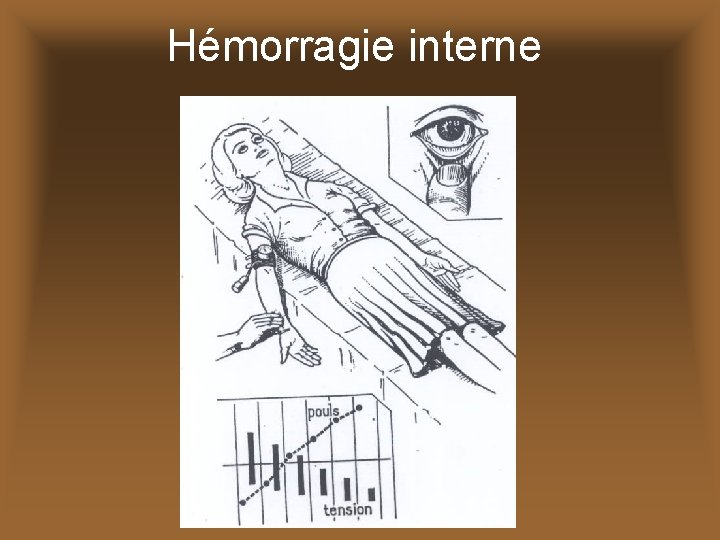 Hémorragie interne 