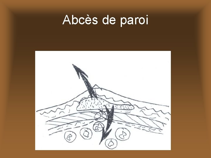 Abcès de paroi 