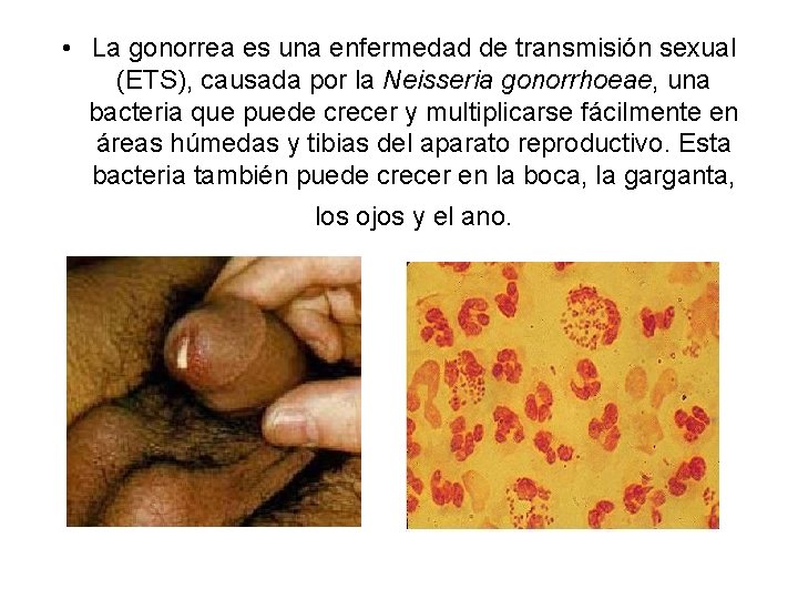  • La gonorrea es una enfermedad de transmisión sexual (ETS), causada por la