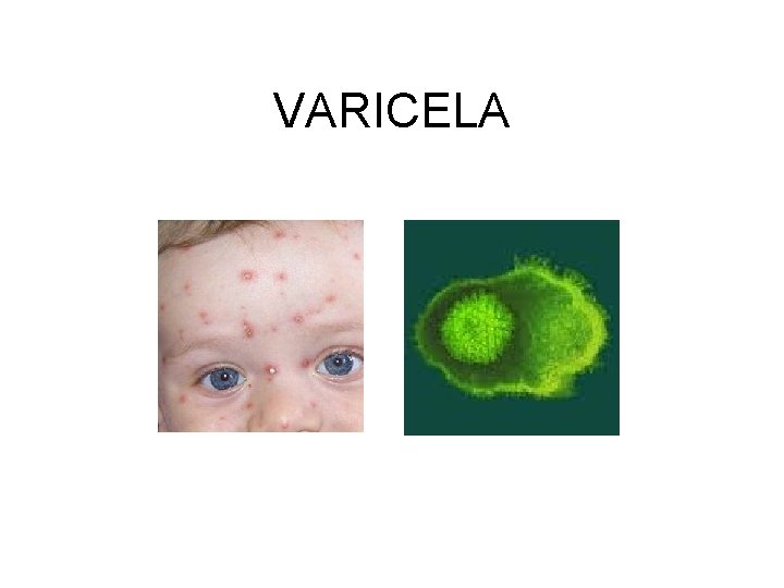 VARICELA 