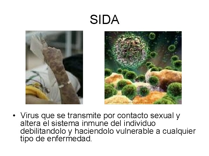 SIDA • Virus que se transmite por contacto sexual y altera el sistema inmune