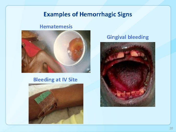 Examples of Hemorrhagic Signs Hematemesis Gingival bleeding Bleeding at IV Site 20 