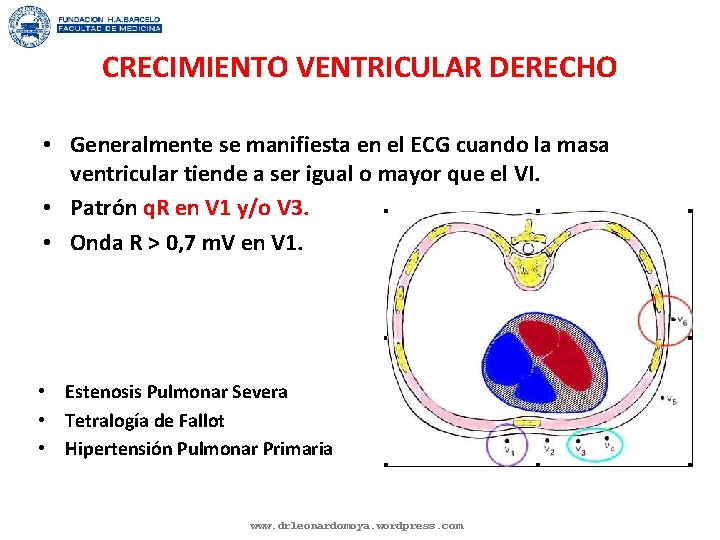 CRECIMIENTO VENTRICULAR DERECHO • Generalmente se manifiesta en el ECG cuando la masa ventricular