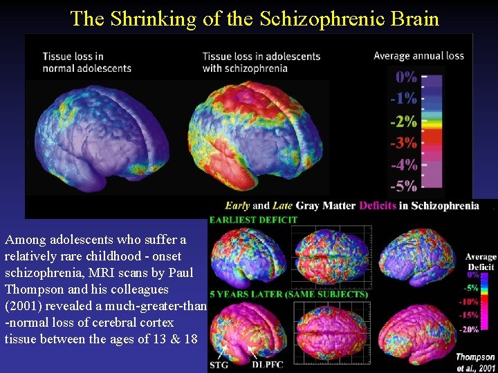 The Shrinking of the Schizophrenic Brain Among adolescents who suffer a relatively rare childhood