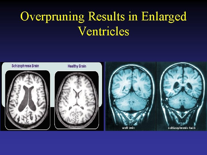 Overpruning Results in Enlarged Ventricles 
